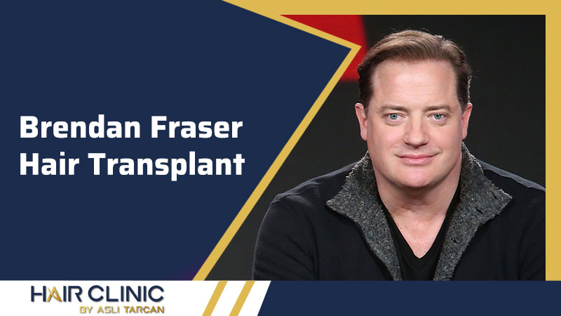 Brendan Fraser Hair Transplant