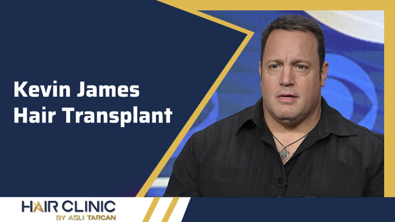 Kevin James Hair Transplant