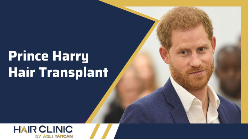 Prince Harry Hair Transplant