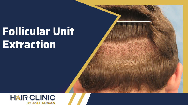 Follicular Unit Extraction » HairClinic By Aslı Tarcan | Hair Transplant