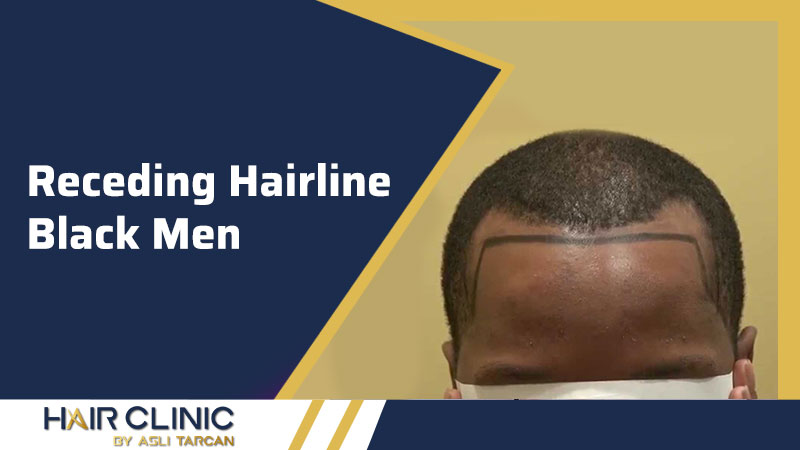 Receding Hairline Black Men