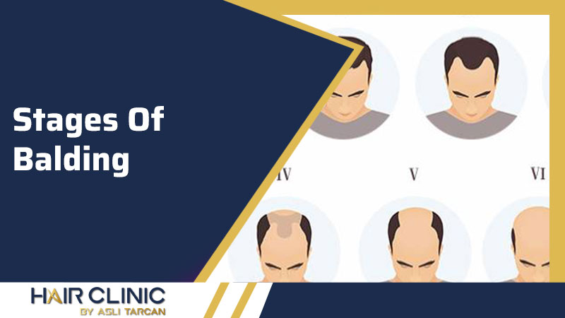 Stages Of Balding