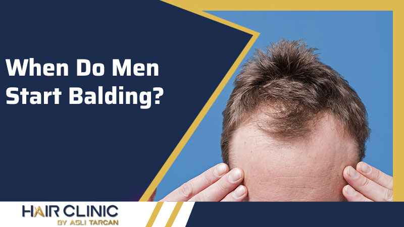 When Do Men Start Balding?