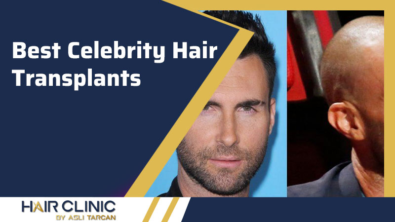 Best Celebrity Hair Transplants