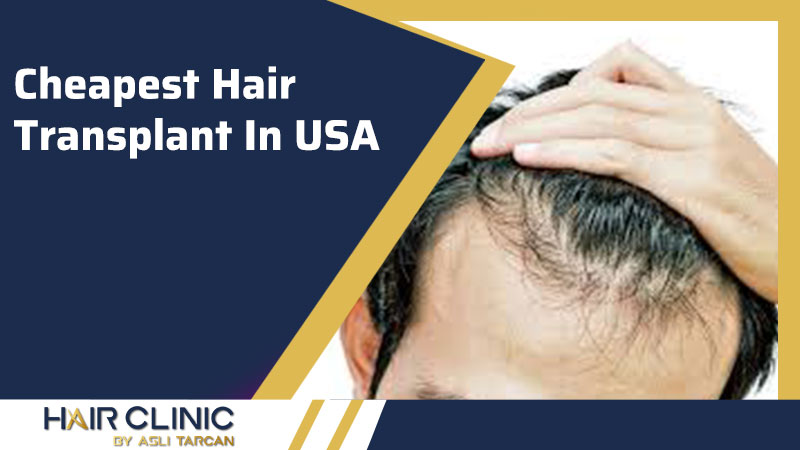 Cheapest Hair Transplant In USA